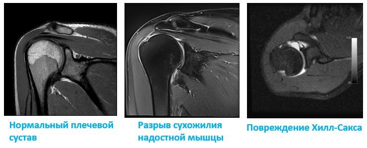 МРТ плечевого сустава - Сеть клиник АО Семейный доктор (Москва) - Изображение 1