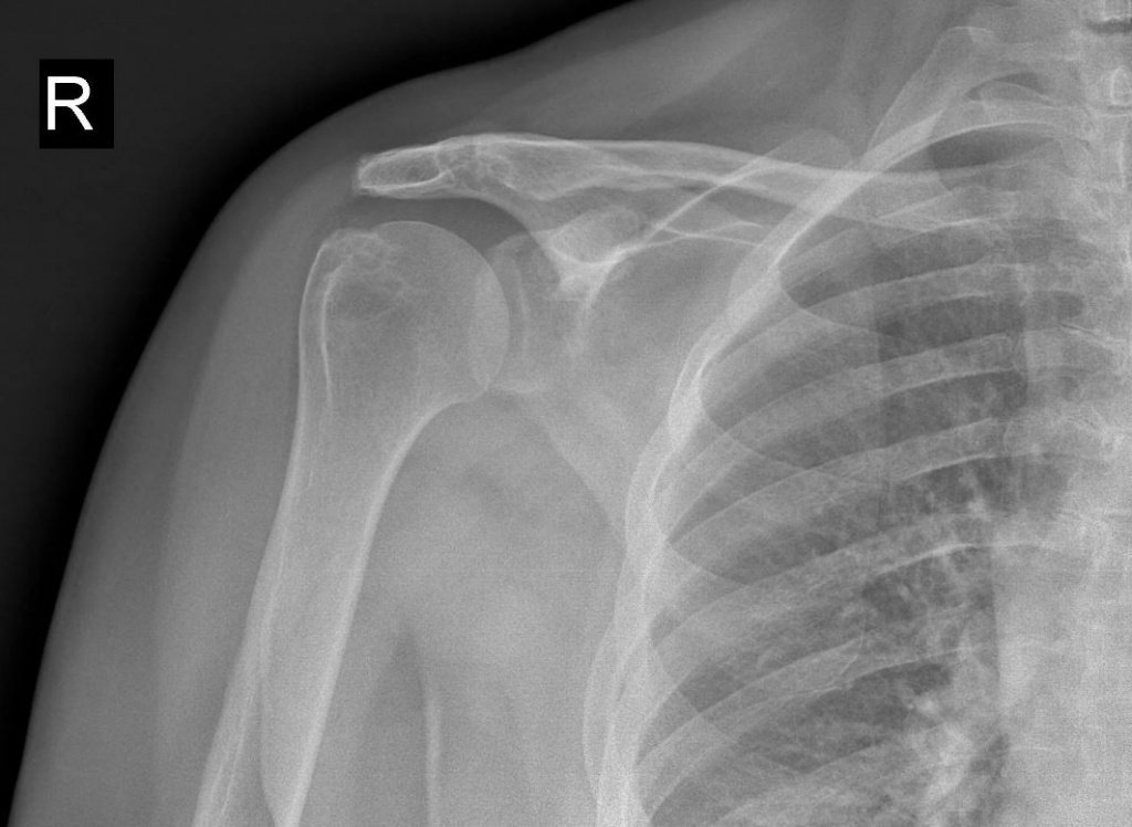 Рентгенография плечевого сустава - Сеть клиник АО Семейный доктор (Москва) - Изображение 1