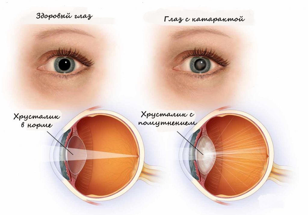Глаз при катаракте - Изображение 1 - Клиника Семейный доктор