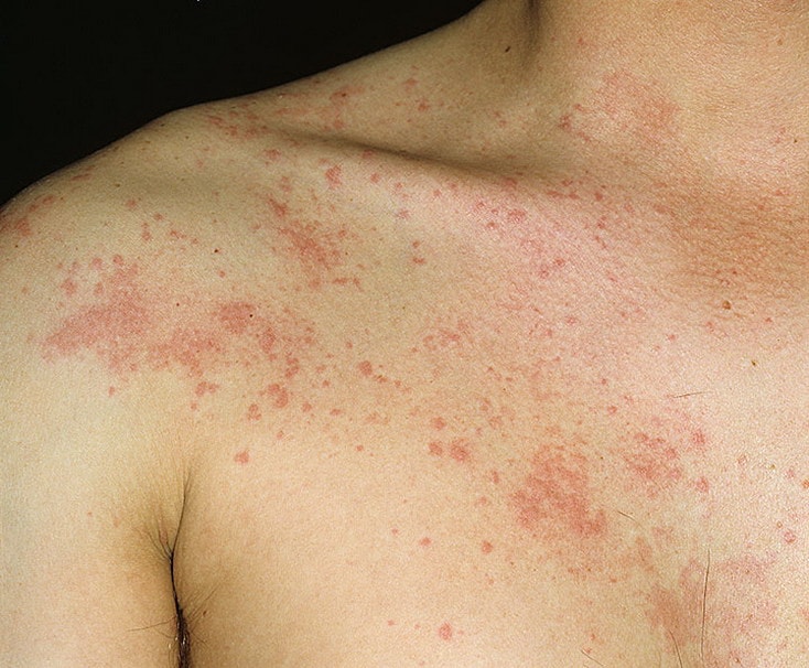 Аллергия на нервной почве: почему возникает и как с ней справиться