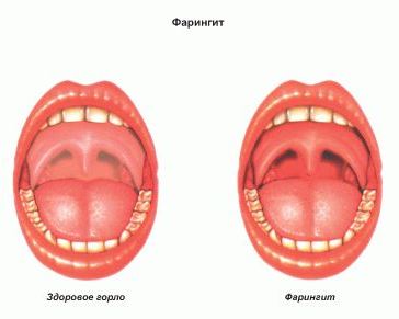 Изображение 1: Фарингит - клиника Семейный доктор