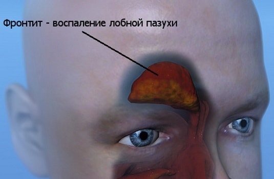 Изображение 1: Фронтит - клиника Семейный доктор