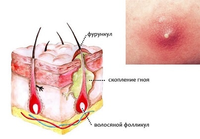 Изображение 1: Фурункул - клиника Семейный доктор