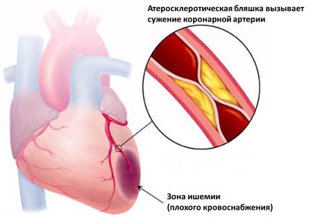 Замирание сердца