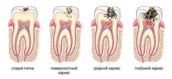 Стадии кариеса