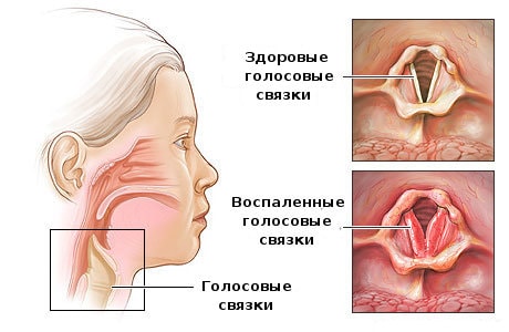 Изображение 2: Ларингит - клиника Семейный доктор