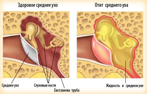 Изображение 1: Средний отит - клиника Семейный доктор