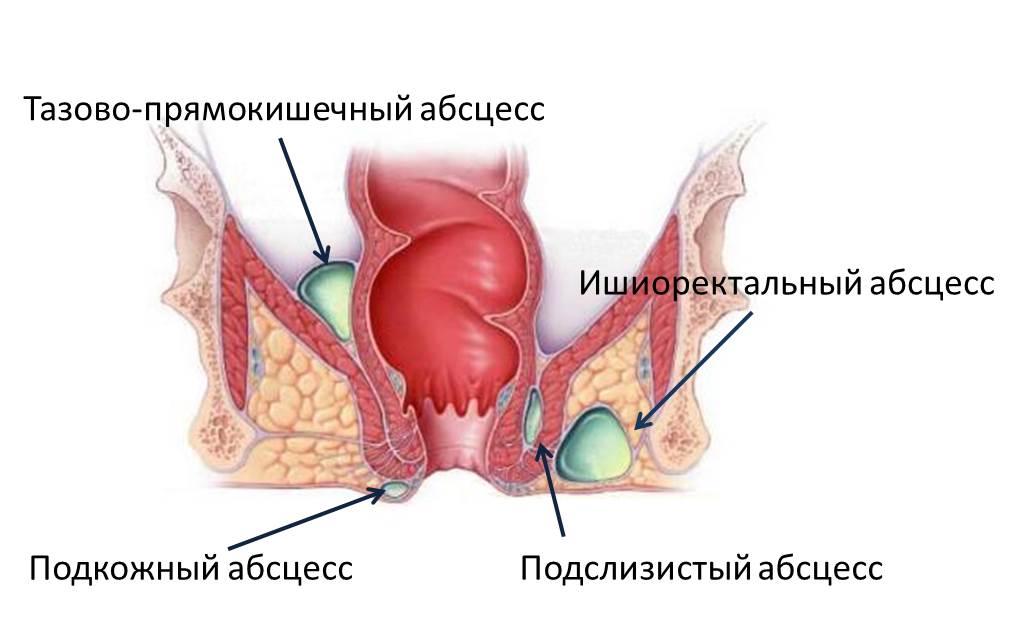 Изображение 1: Парапроктит - клиника Семейный доктор