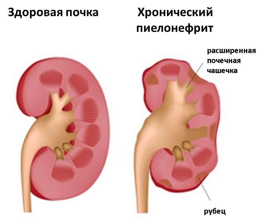 Изображение 2: Пиелонефрит - клиника Семейный доктор