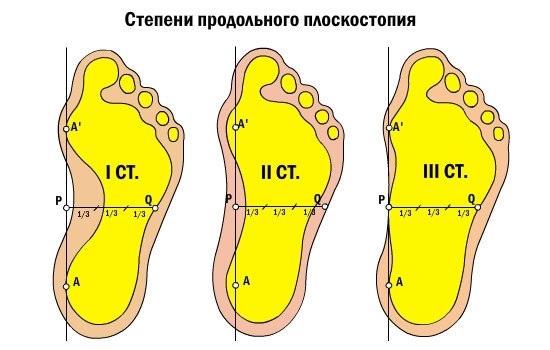 Плоскостопие 3 Степени Фото