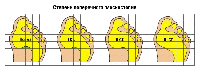 Изображение4: Плоскостопие - клиника Семейный доктор