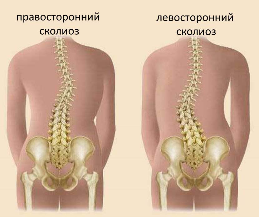 Сколиоз 3 Фото