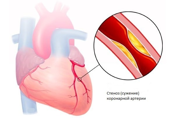Изображение 1: Стенокардия – клиника Семейный доктор