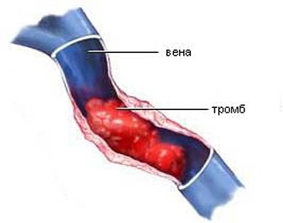 Изображение 2: Тромбофлебит - клиника Семейный доктор