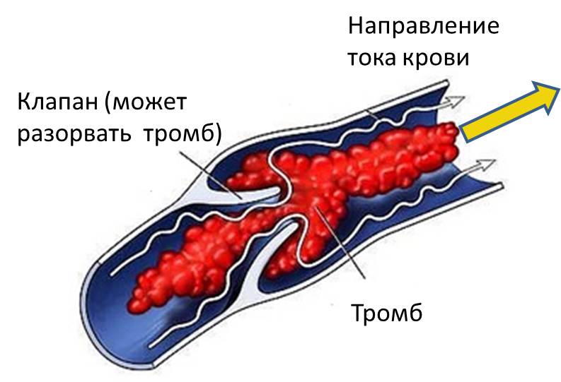 Изображение 3: Тромбофлебит - клиника Семейный доктор