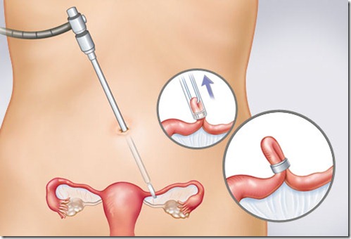 Перекрытие труб у женщин лапароскопическая операция