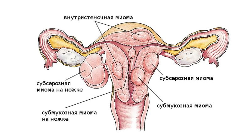 Миома матки