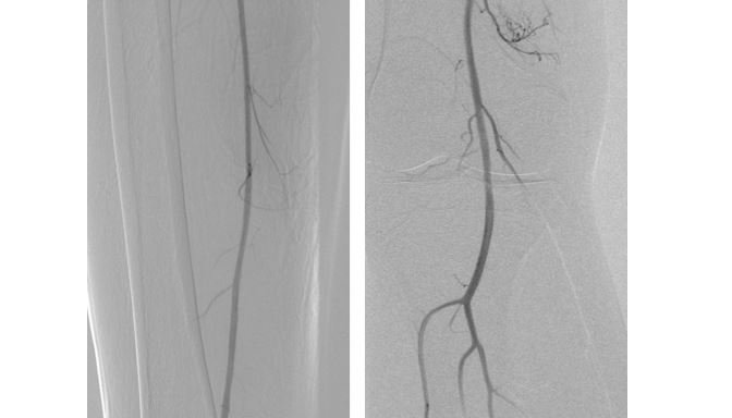 Ангиография артерий нижних конечностей