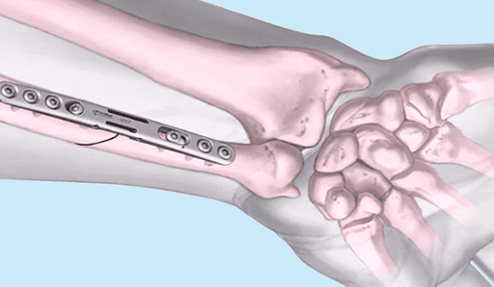 Остеосинтез при переломах рук