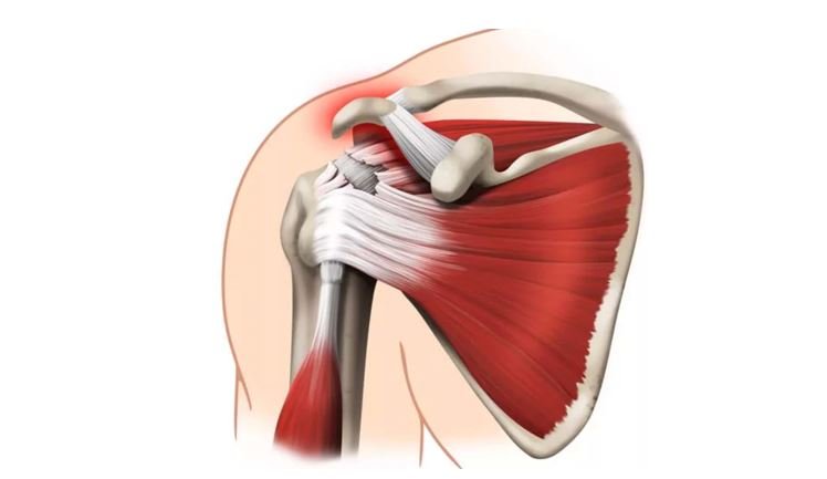 Разрыв сухожилия плечевого сустава