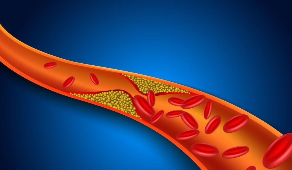 Атеросклероз артерий нижних конечностей