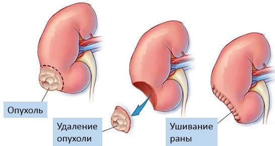 Резекция почки