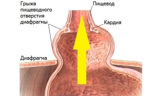 Грыжа пищеводного отверстия диафрагмы 