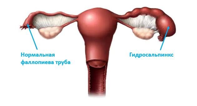 Гидросальпинкс