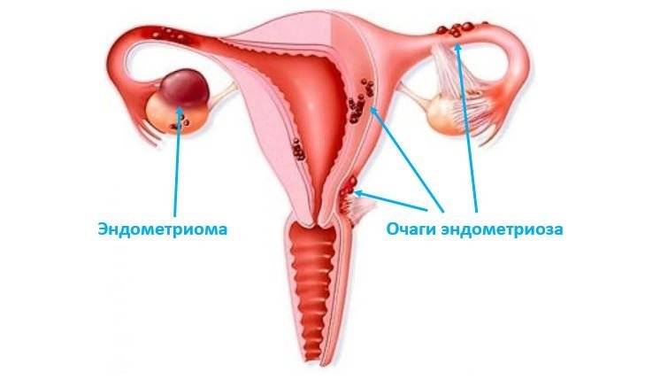 Эндометриоидная киста яичника