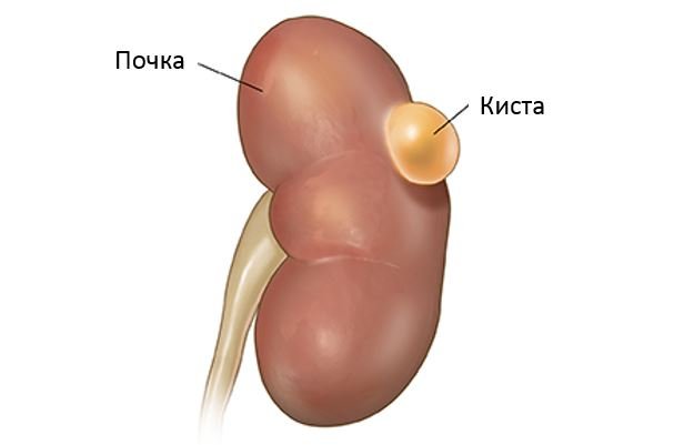 Иссечение кисты почки