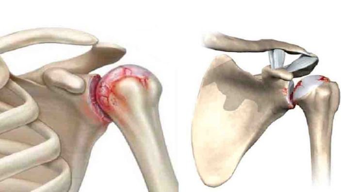 Артроз плечевого сустава
