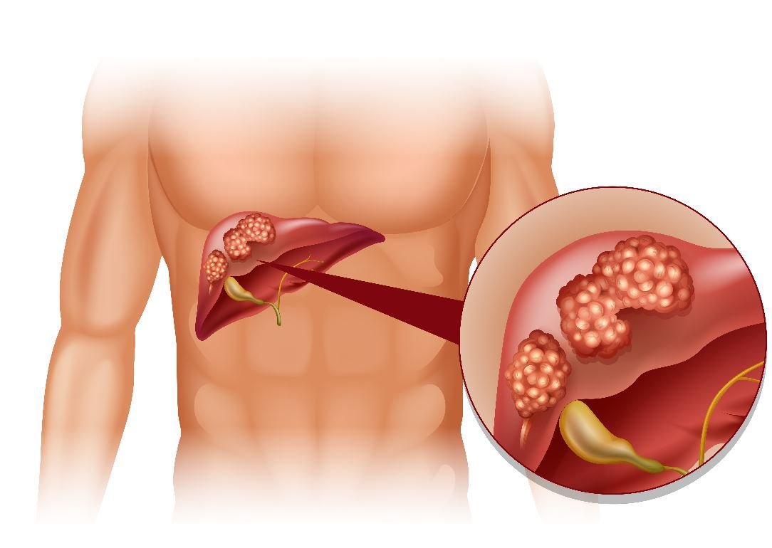 Рак печени