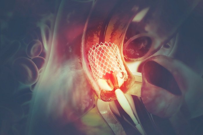 Баллонная ангиопластика и стентирование артерий нижних конечностей
