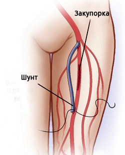 Изображение 4: Атеросклероз сосудов нижних конечностей - клиника Семейный доктор