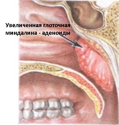 Изображение 2: Аденоиды - клиника Семейный доктор
