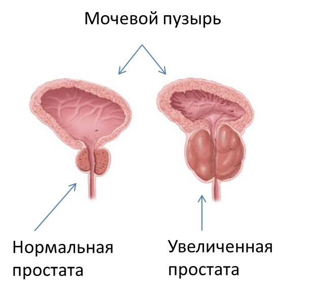 Изображение 2: Аденома простаты - клиника Семейный доктор