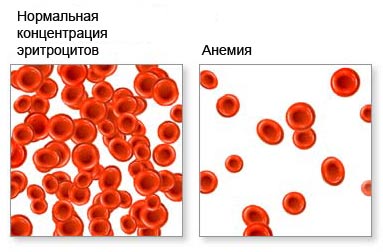 К каким врачам обращаться при железодефицитной анемии thumbnail