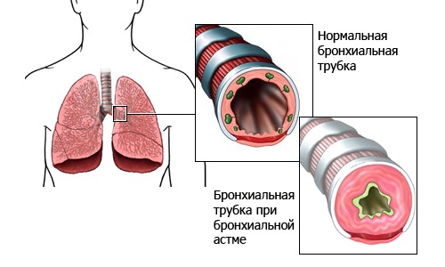 Факторы риска заболевания бронхиальной астмой thumbnail
