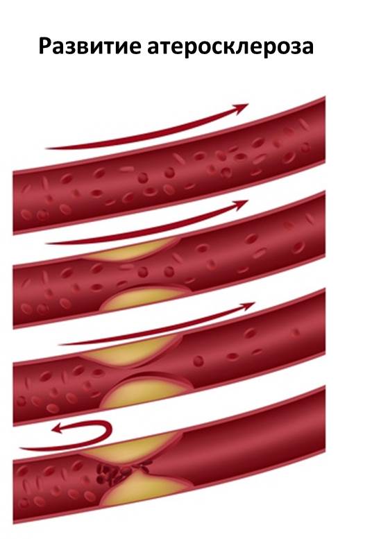 Изображение 1: Атеросклероз - клиника Семейный доктор