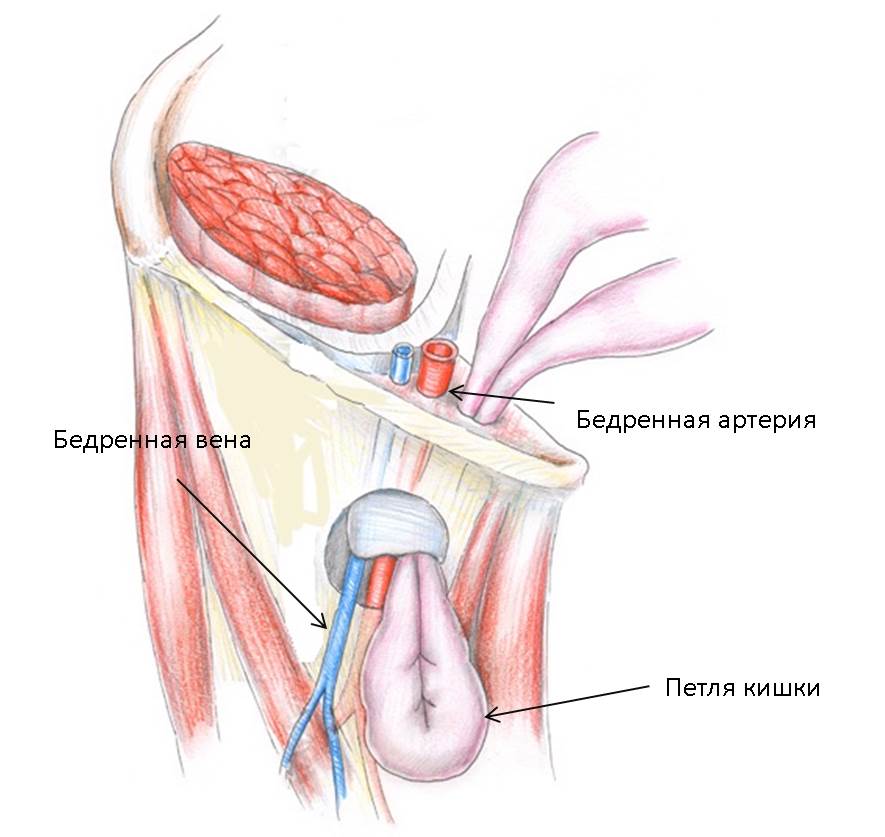 Ущемленная бедренная грыжа. Паховые и бедренные грыжи. Паховые и бедренные грыжи хирургия. Бедренный канал и бедренная грыжа.