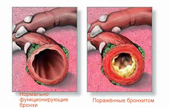 Изображение 1: Бронхит - клиника Семейный доктор