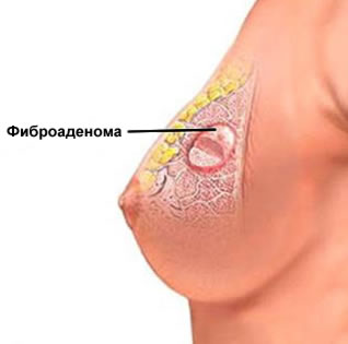 Гормональные изменения и рост груди