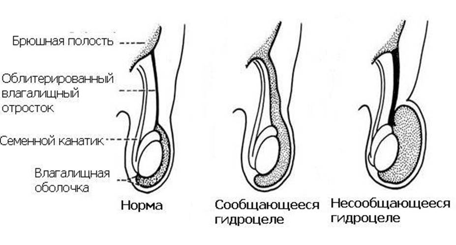 Изображение 3: Водянка яичка - клиника Семейный доктор