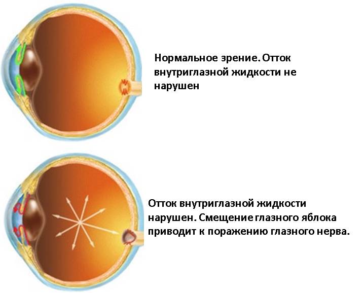 Глазное давление у взрослых