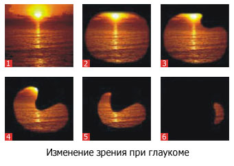 Изображение 2: Глаукома - клиника Семейный доктор