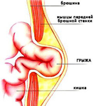 Изображение 2: Грыжа живота - клиника Семейный доктор