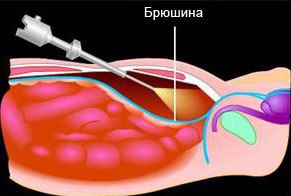 Изображение 2: Удаление грыжи - Лапароскопическая герниопластика - клиника Семейный доктор