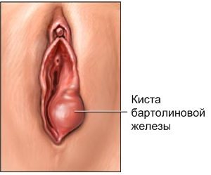 Изображение 2: Удаление кисты бартолиновой железы - клиника Семейный доктор