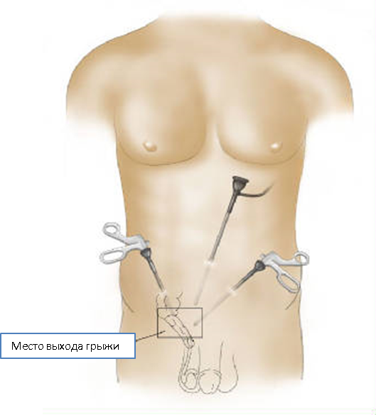 Изображение 1: Удаление грыжи - Лапароскопическая герниопластика - клиника Семейный доктор