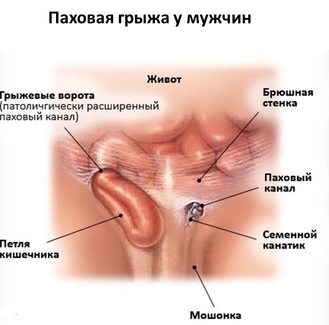 Изображение 3: Грыжа живота - клиника Семейный доктор